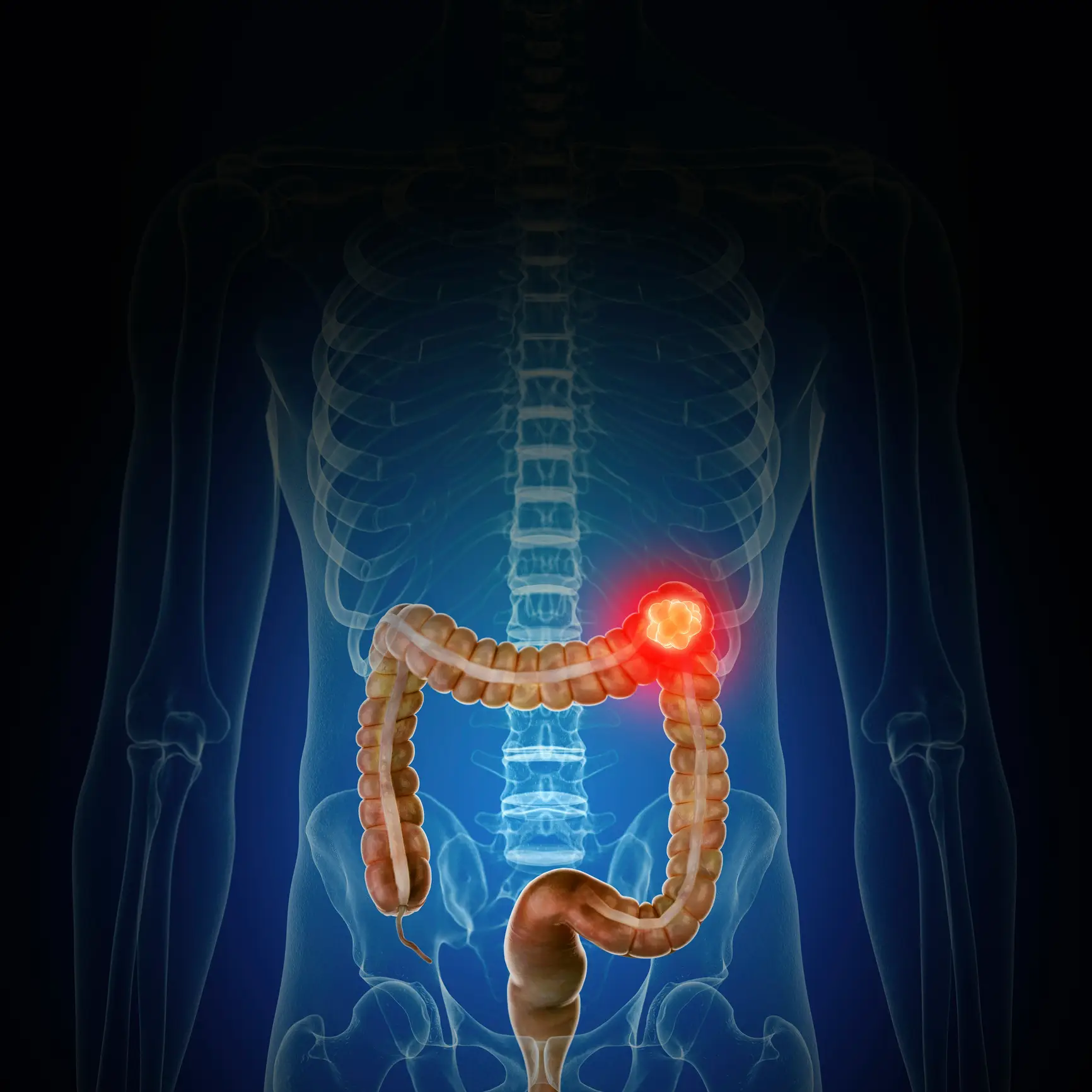 Signs of colon cancer are easy to miss (Getty Stock Images)