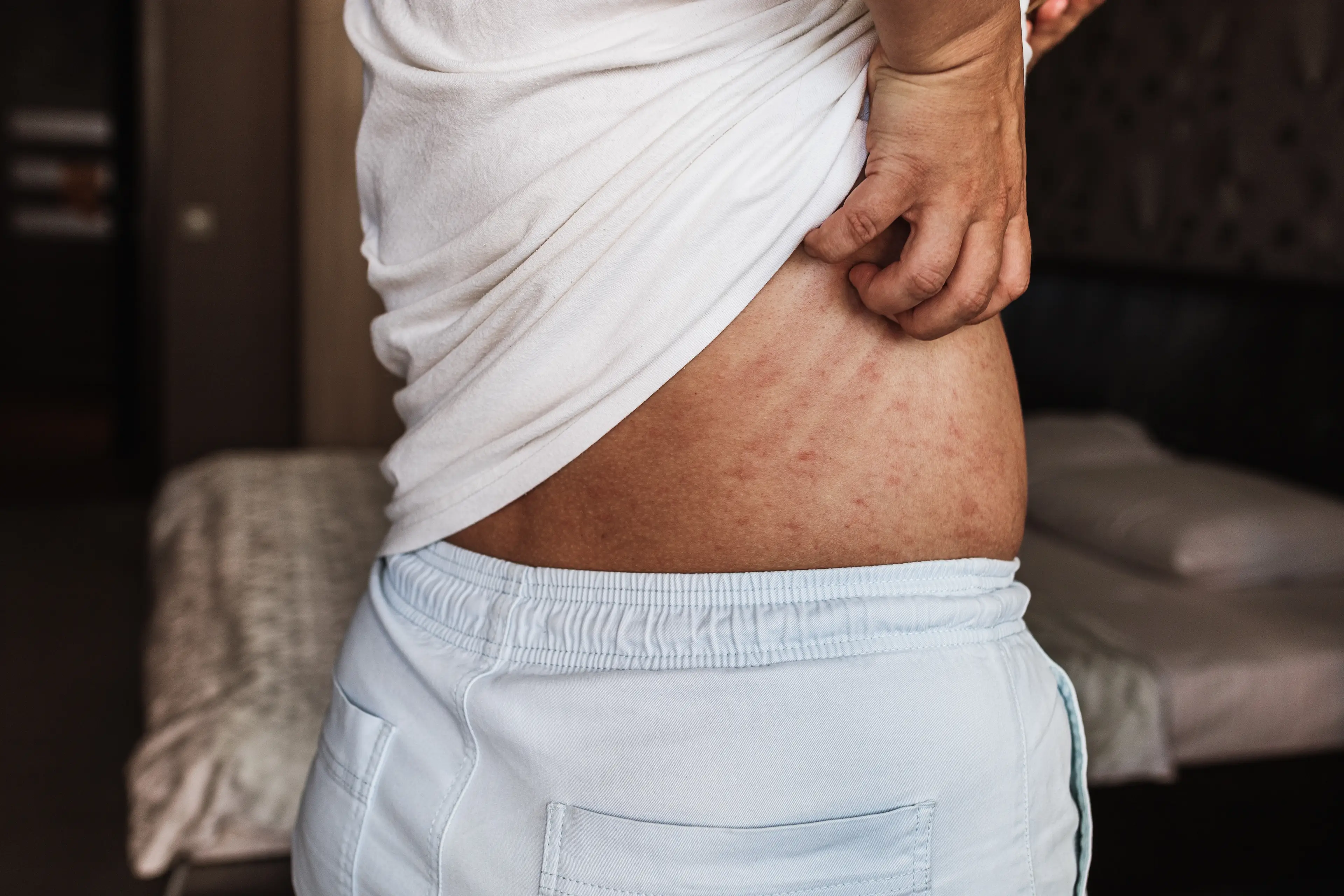 Itchy skin can be common for those with CKD. (Getty Stock)