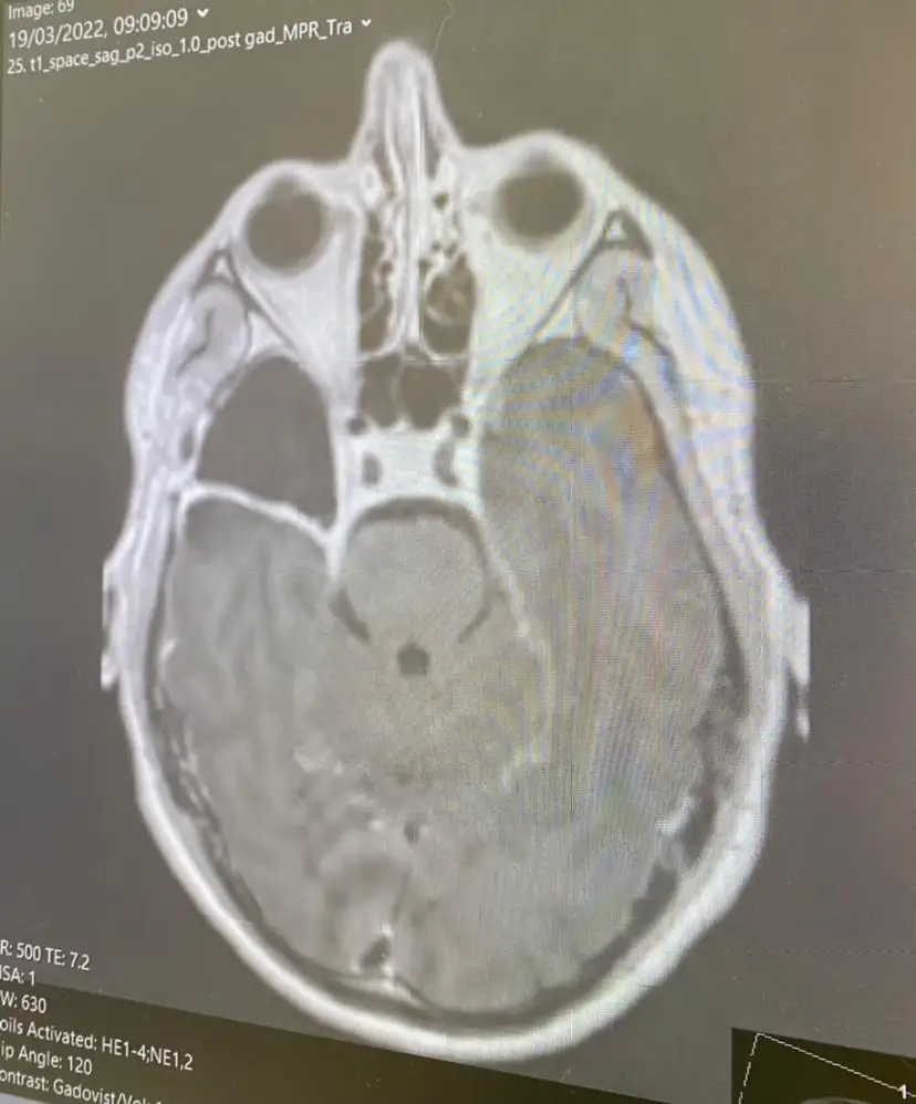 Alex lost around a quarter of the right side of his brain.