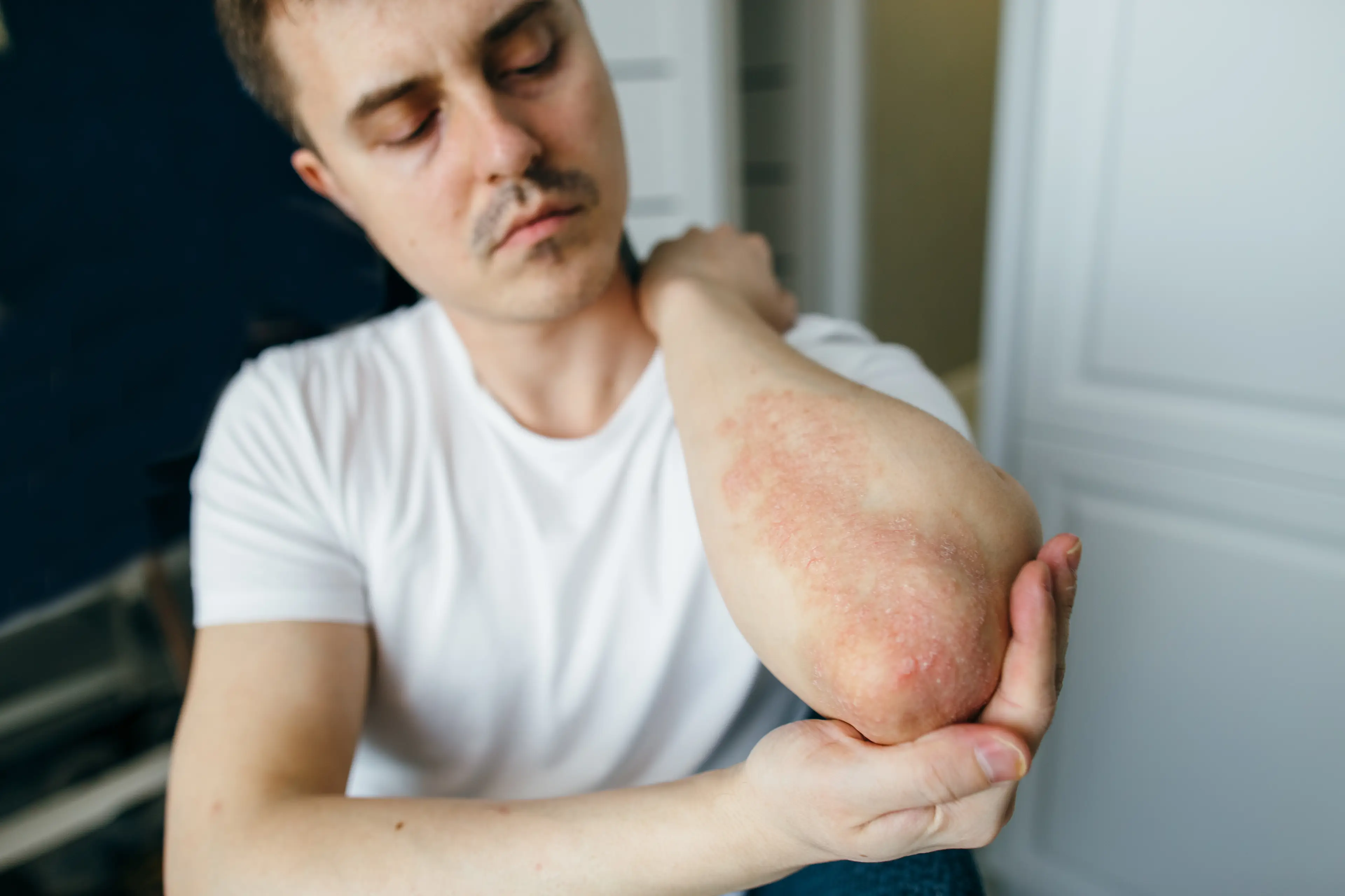 Psoriasis has now been linked to potentially causing Crohn's disease (Getty Stock Images)