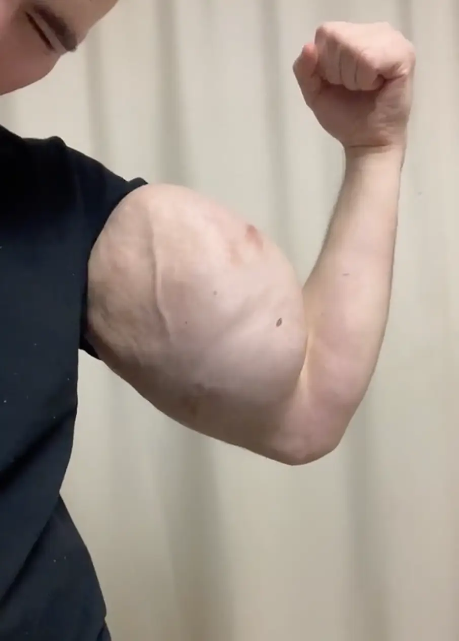 'Russian Popeye' faces more operations in the future.