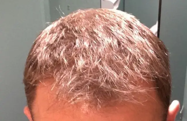 Five months after using the Regaine Hair Treatment (Image credit: JCS / Amazon Reviews)