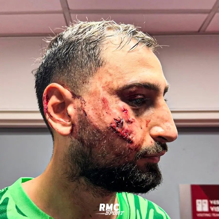 Gianluigi Donnarumma suffered horrific injuries on Wednesday evening. Image: RMC Sport