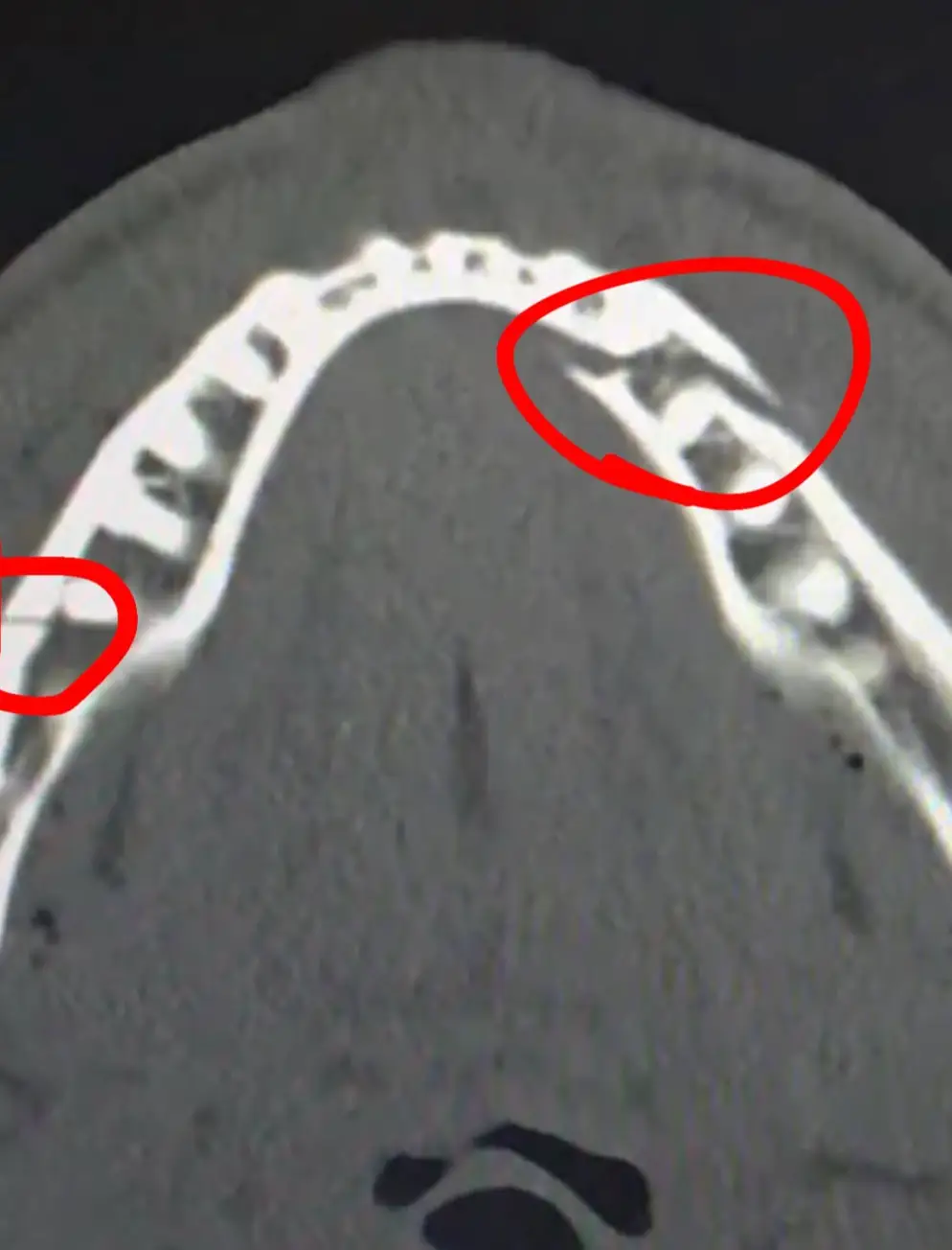 Paul has suffered a broken jaw. Image credit: Instagram/jakepaul