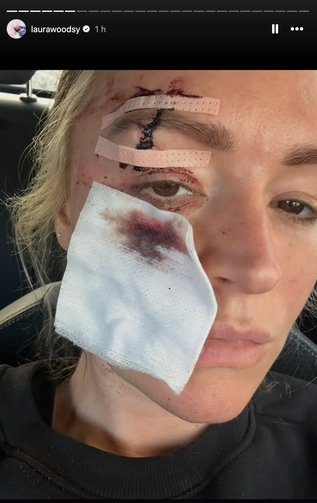 Woods also shared images of her face following the operations. (Image: laurawoodsy/Instagram)