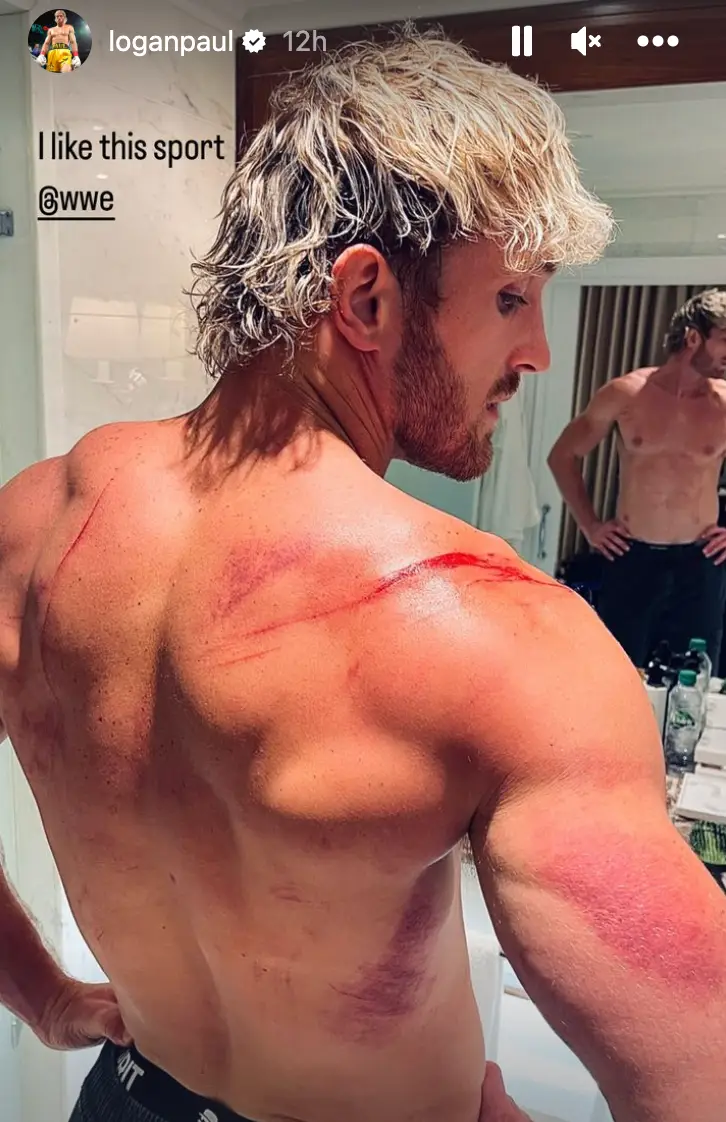 Logan Paul shows off his injuries. Image: Instagram