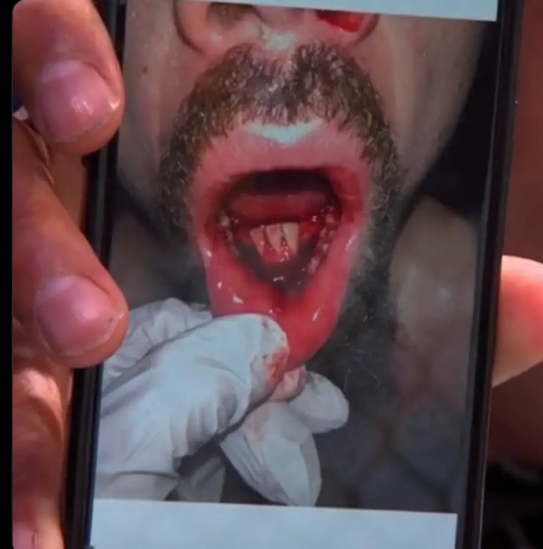 Robert Whitakker sustained a gruesome injury (