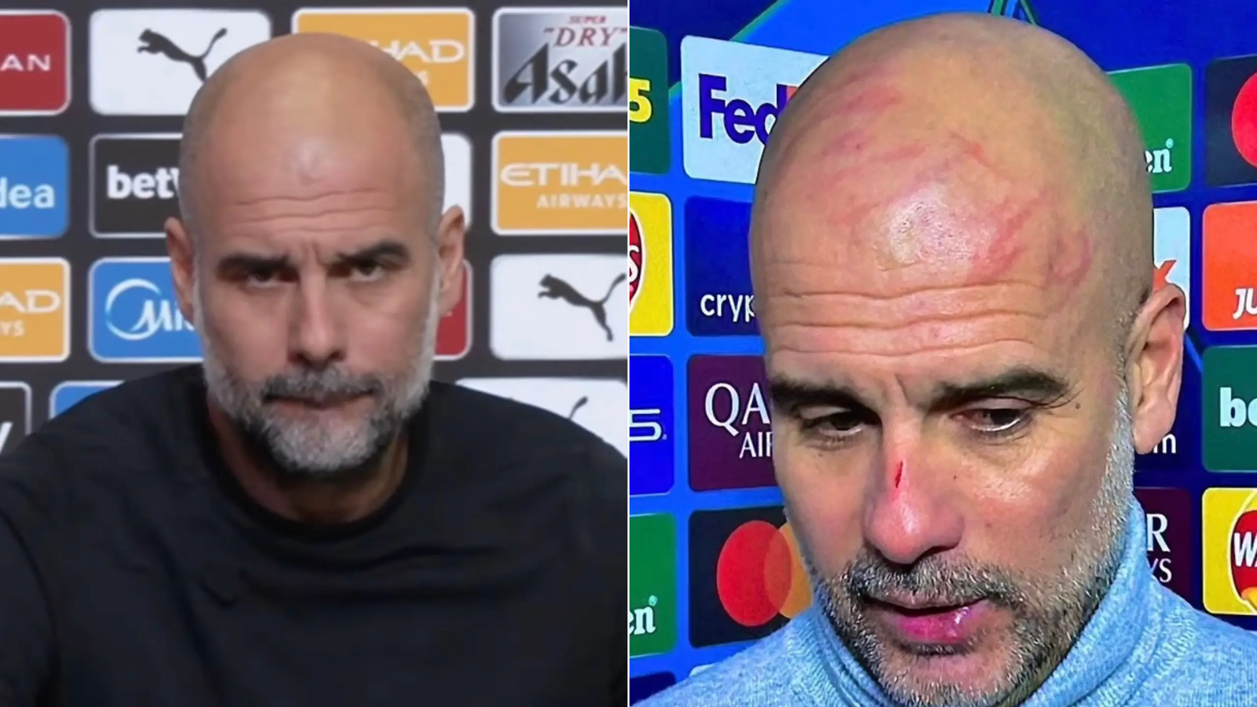 Pep Guardiola breaks his silence to reveal the real reason for the scratches on his head