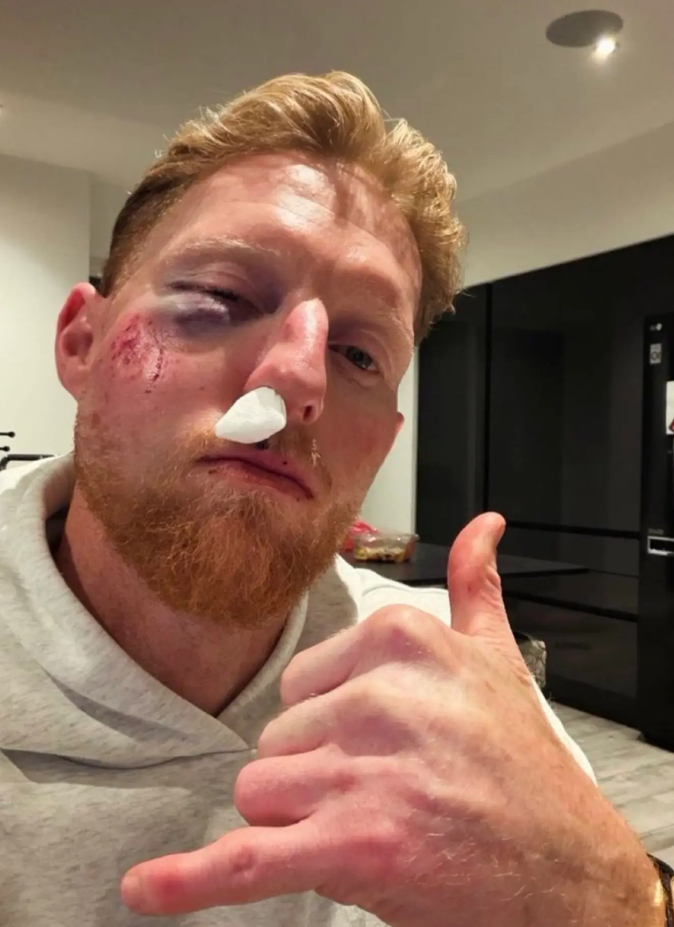 Ben Stokes suffered a broken cheekbone (Credit:BenStokes)