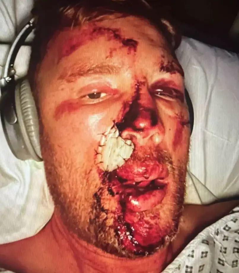 Freddie Flintoff sustained serious facial injuries following his Top Gear crash. Image: Disney+