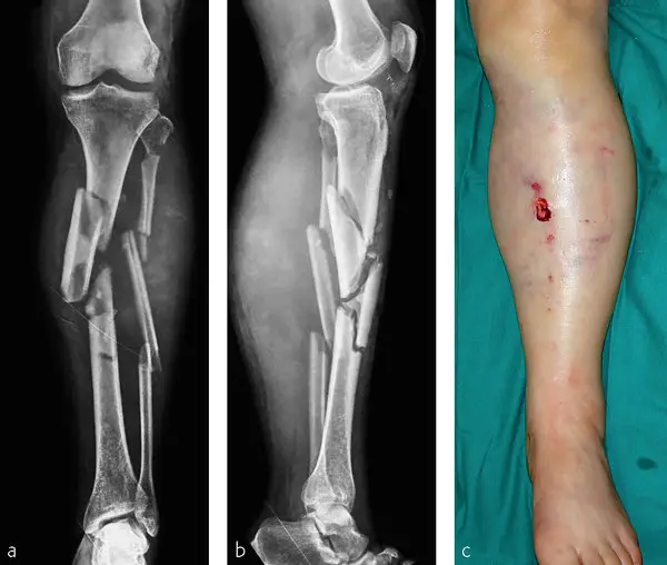 The medical professional shared images of a similar injury on social media. (Image: DrJesseMorse)