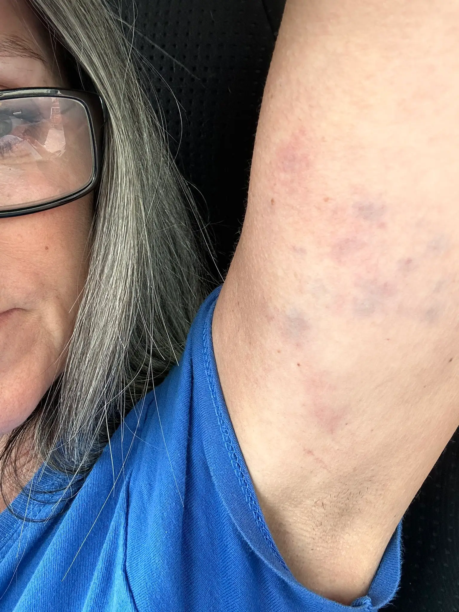 Jean Hatchet showed off bruises suffered from the incident. Image: X/@JeanHatchet