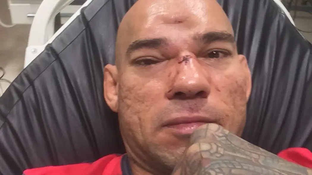 Evangelista Santos suffered a fractured skull in his defeat to Michael Page. Image: Instagram/Evangelista Santos