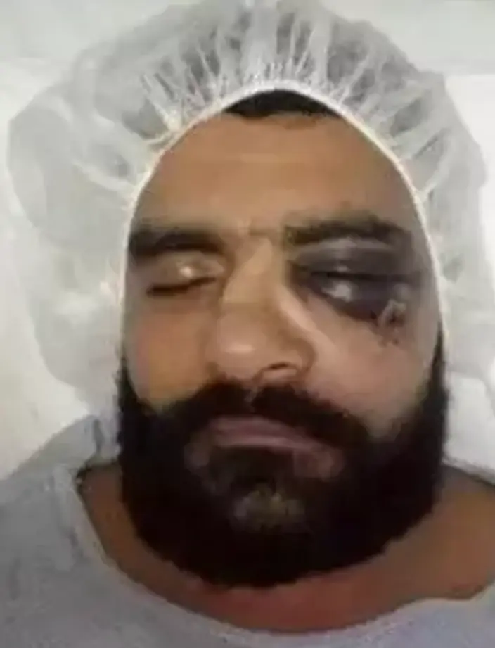 Hassan's face was a mess after the knockout. Image: India Times