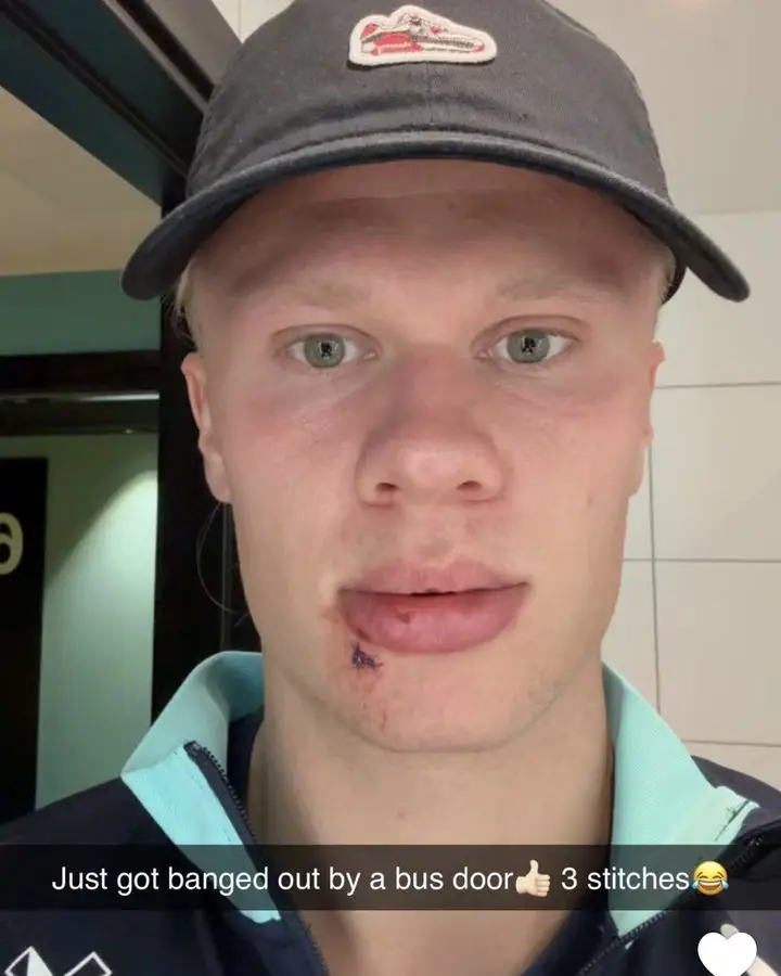 Haaland suffered a facial injury while away with Norway. (Image: Snapchat)