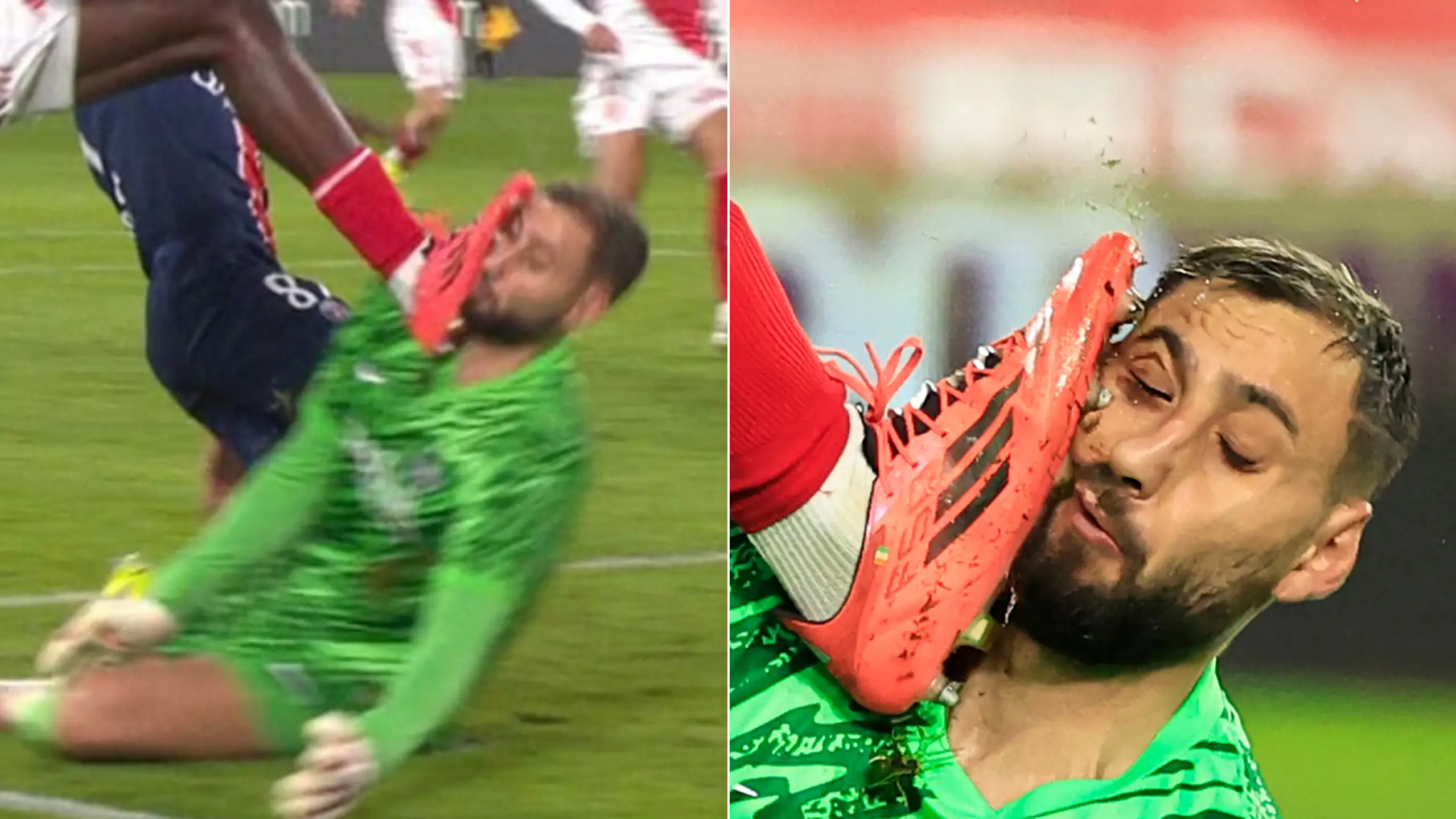 PSG's Gianluigi Donnarumma shows off shocking facial injuries after nasty collision with Monaco star