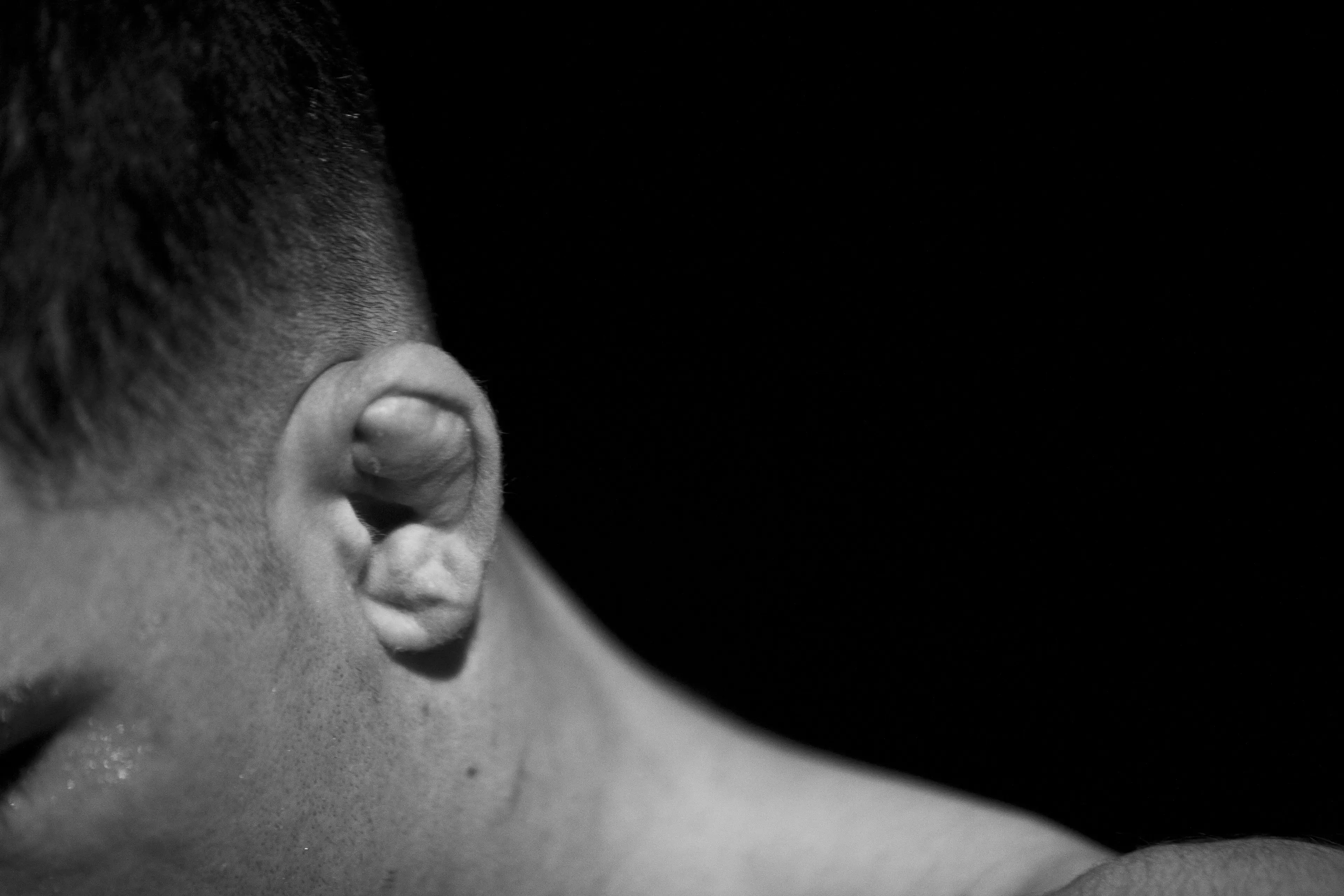 Cauliflower ear (Photo by David S. Holloway/Getty Images)