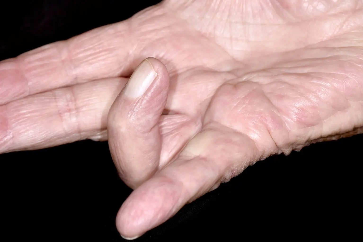Eventually, one or more of your fingers may get stuck in a bent position. Image credit: NHS