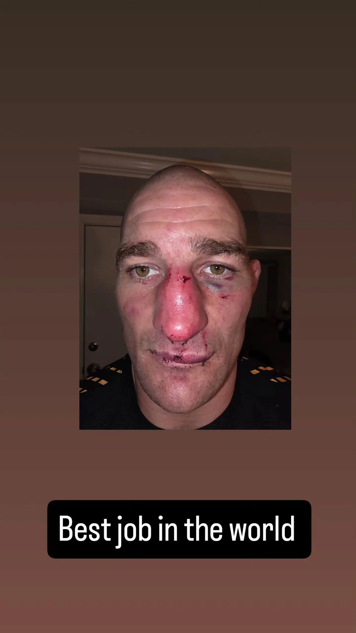 Sean Strickland's face following his UFC 328 win (Instagram)