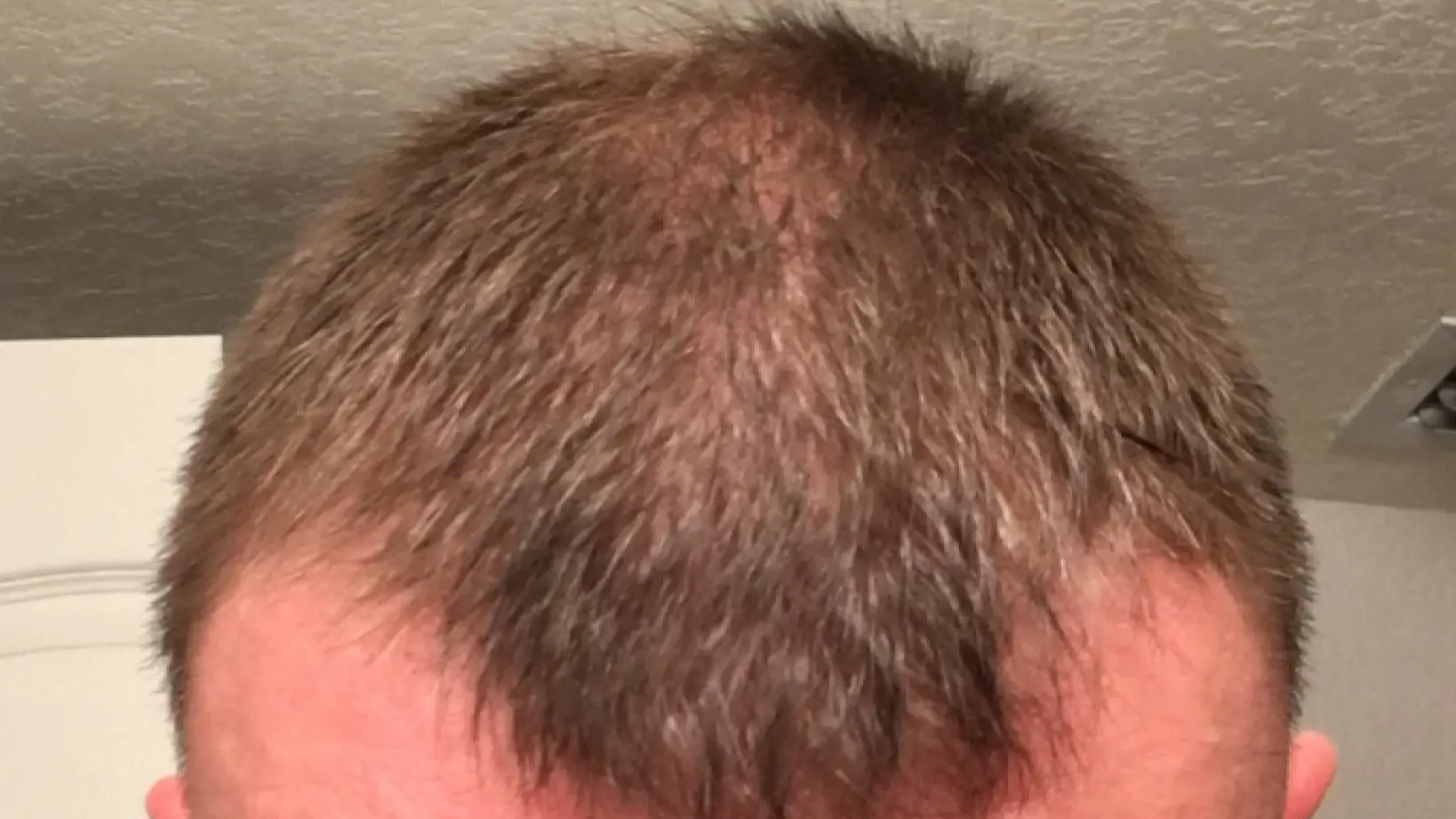 From losing hair to weekly cuts - what 40% of UK men going bald need to know