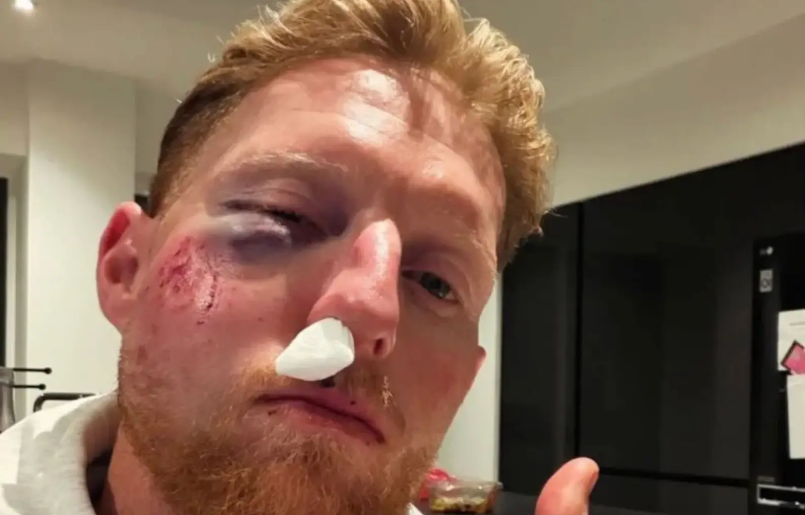 Ben Stokes shared his gruesome injury on social media (Image: Instagram/stokesy)