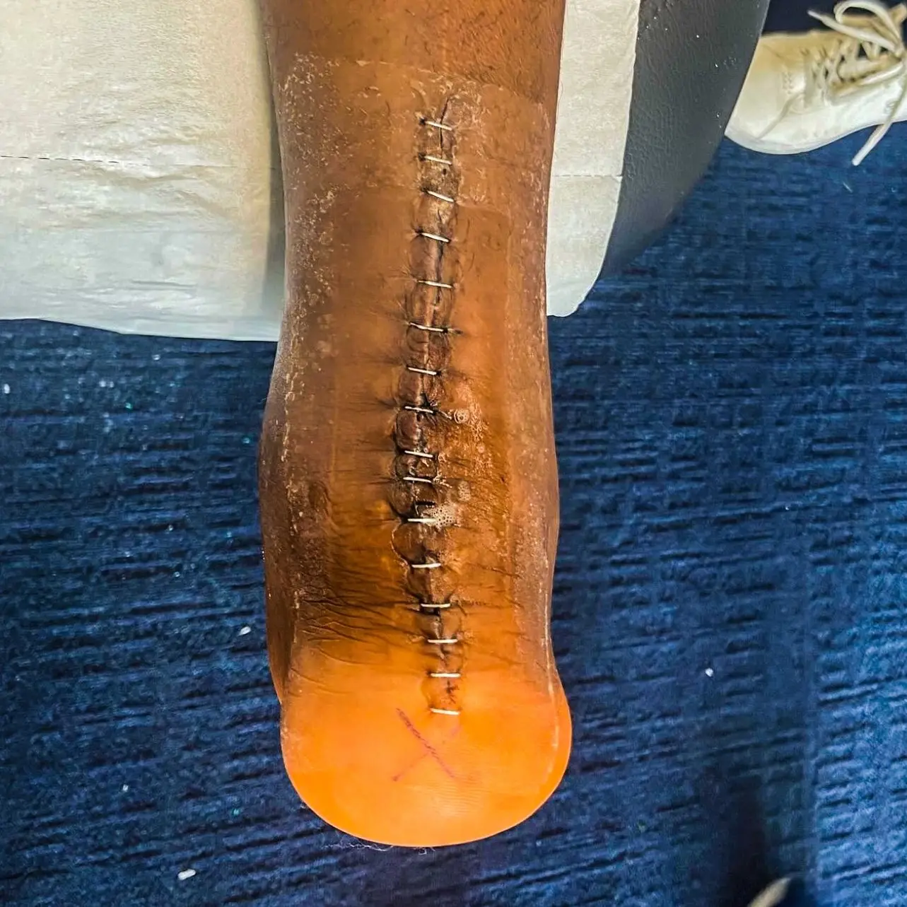 Kimpembe suffered a similar injury to Hugo Ekitike back in 2023. (Image: Instagram/kimpembe3)
