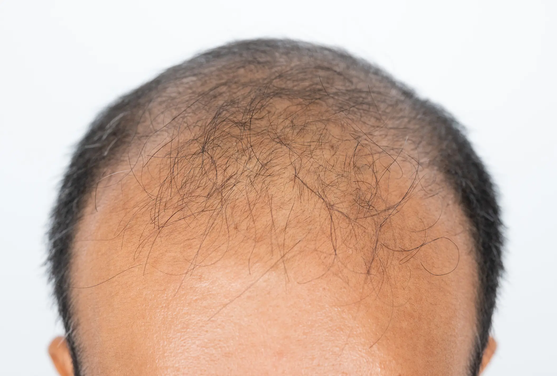 Hair loss is something that most people have to deal with as they age (Getty Stock)