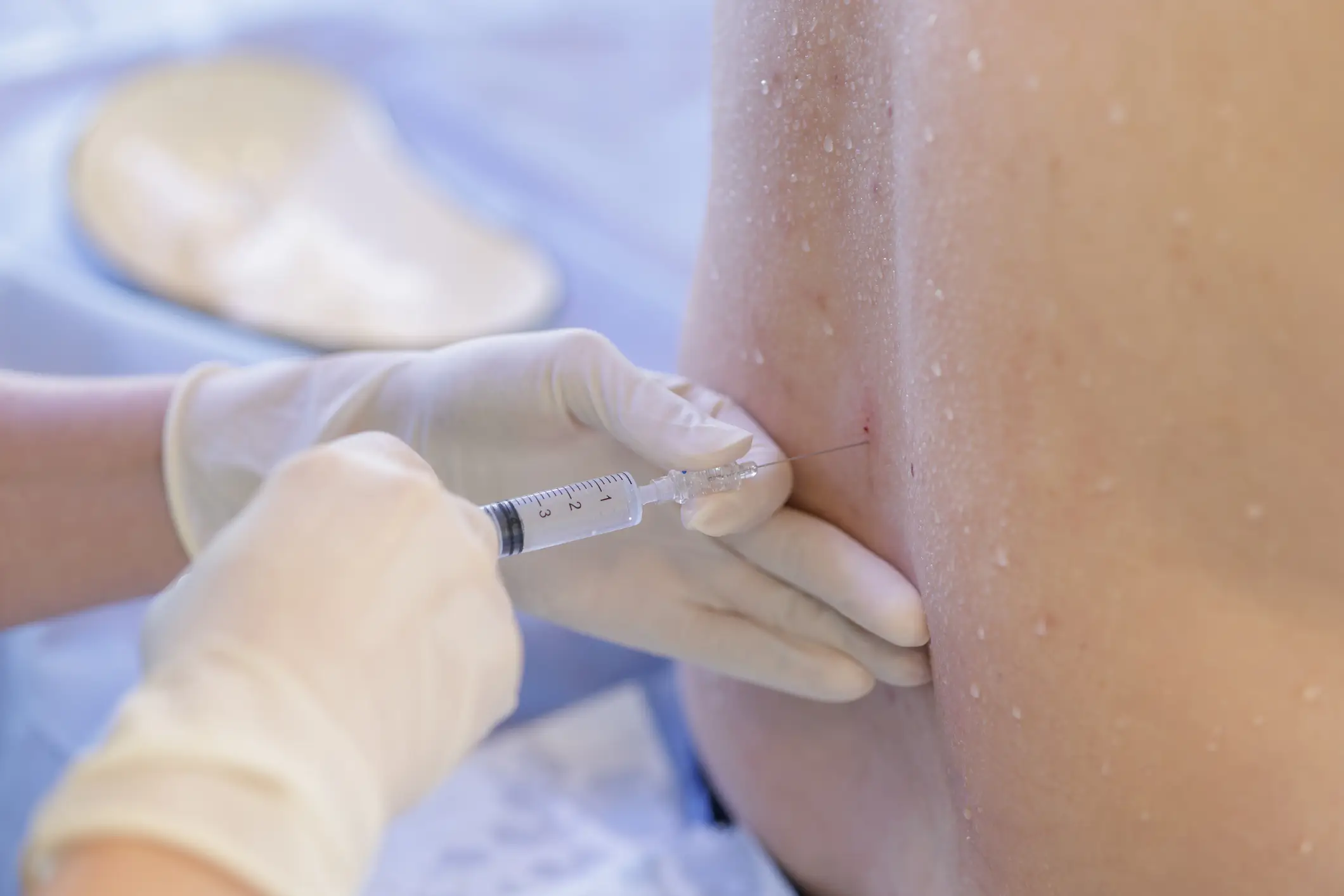 Lumbar punctures require patients to be awake (Sergii Kolesnikov / Getty)