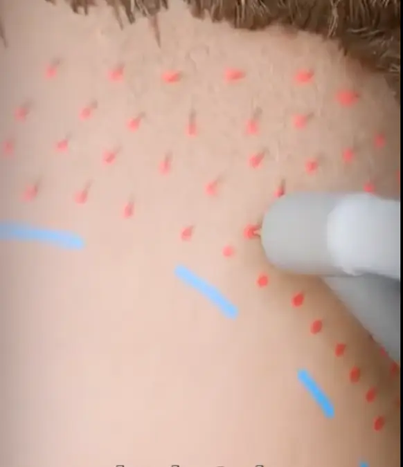 Each hair follicle is planted in the balding areas / u/Mrcinemazo9nn/Reddit