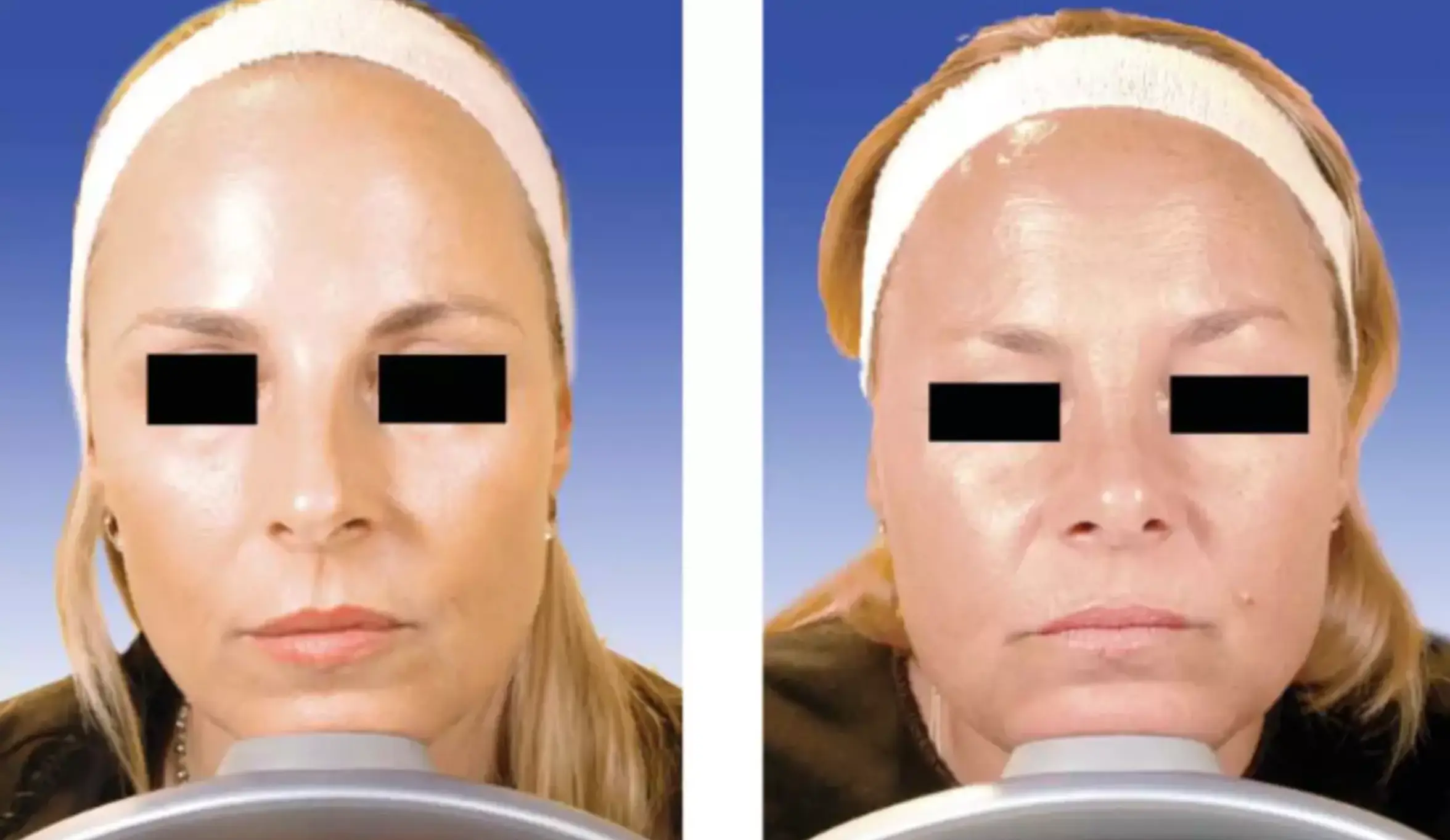 Twin 1 (right) appeared to have a fuller face and jaw after 19 years with minimal Botox (American Society for Dermatologic Surgery)