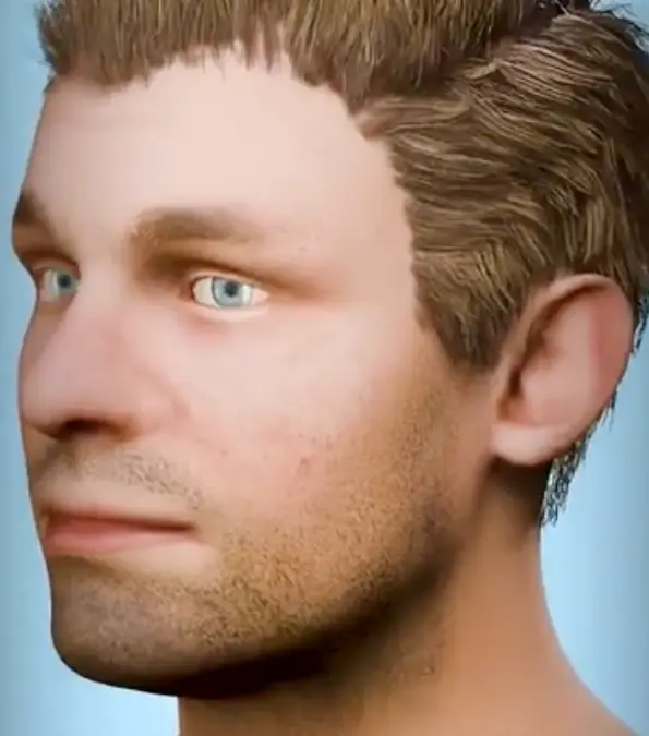 A fascinating animation shows how hair transplants work / u/Mrcinemazo9nn/Reddit