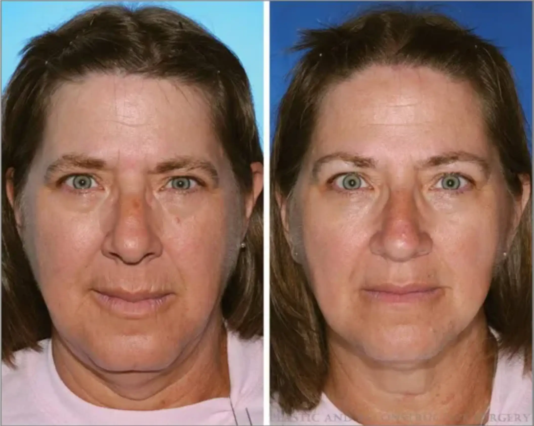 The twin on the left is a smoker and the twin on the right is not (American Society of Plastic Surgeons)