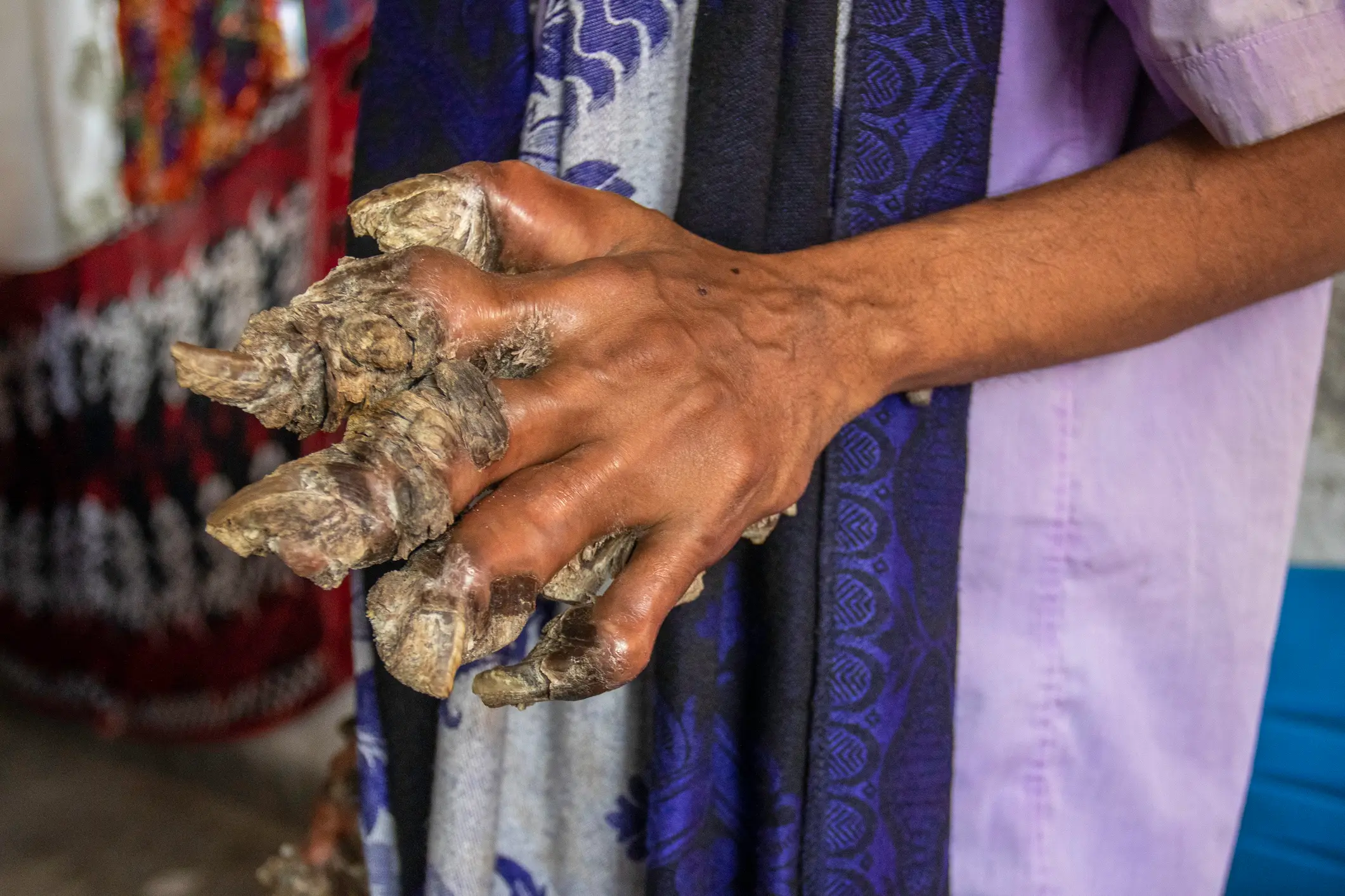 Abul Bajandar suffers from a condition that causes tree-like formations to grow on his limbs. (ZHC_Anando/Getty)