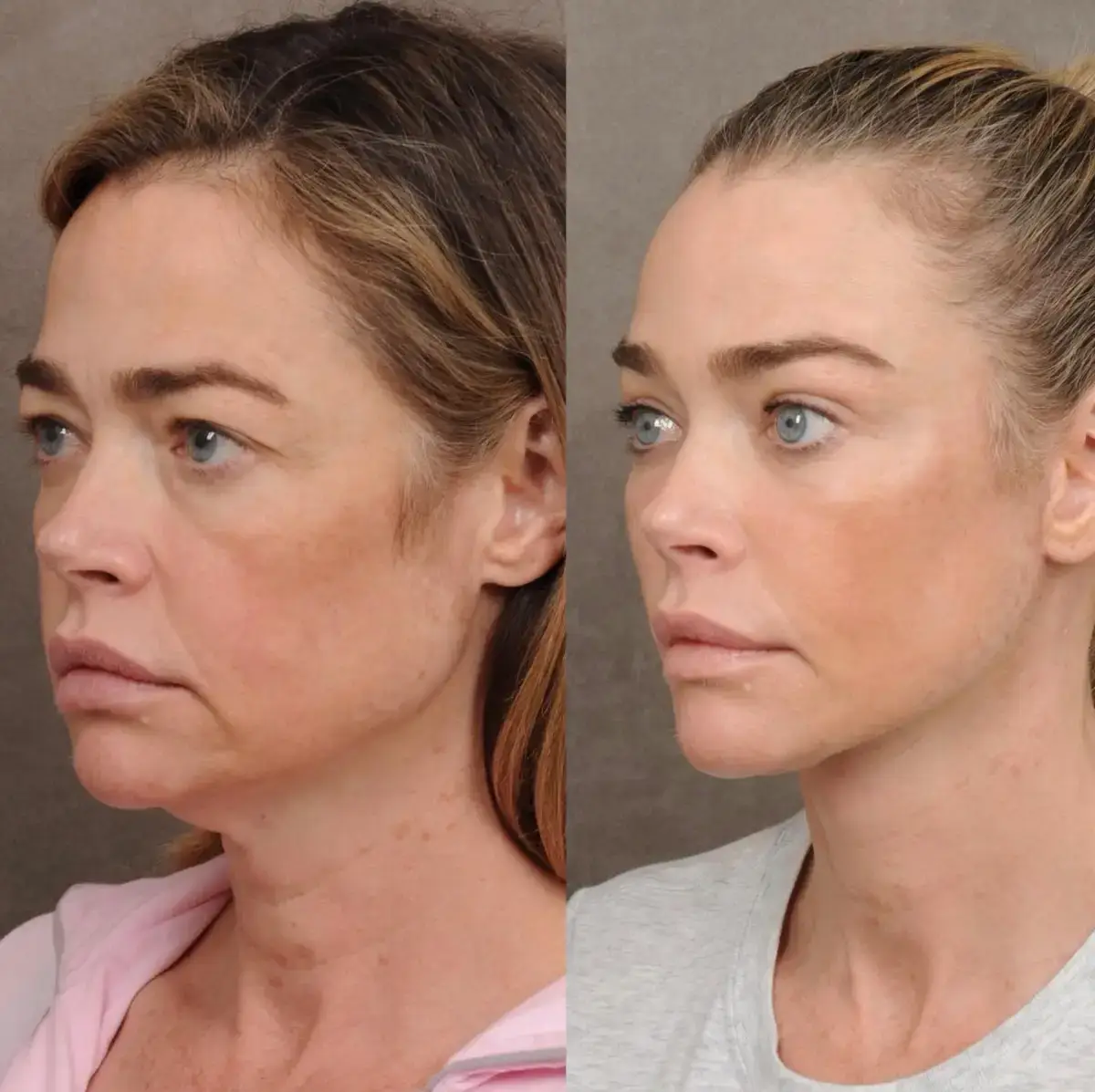 Before and after the surgery (Instagram/@drbentalei)