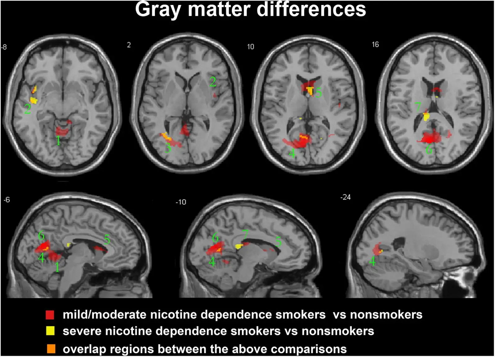 Different MRI scans has revealed the shocking results of smoking (Frontiers)