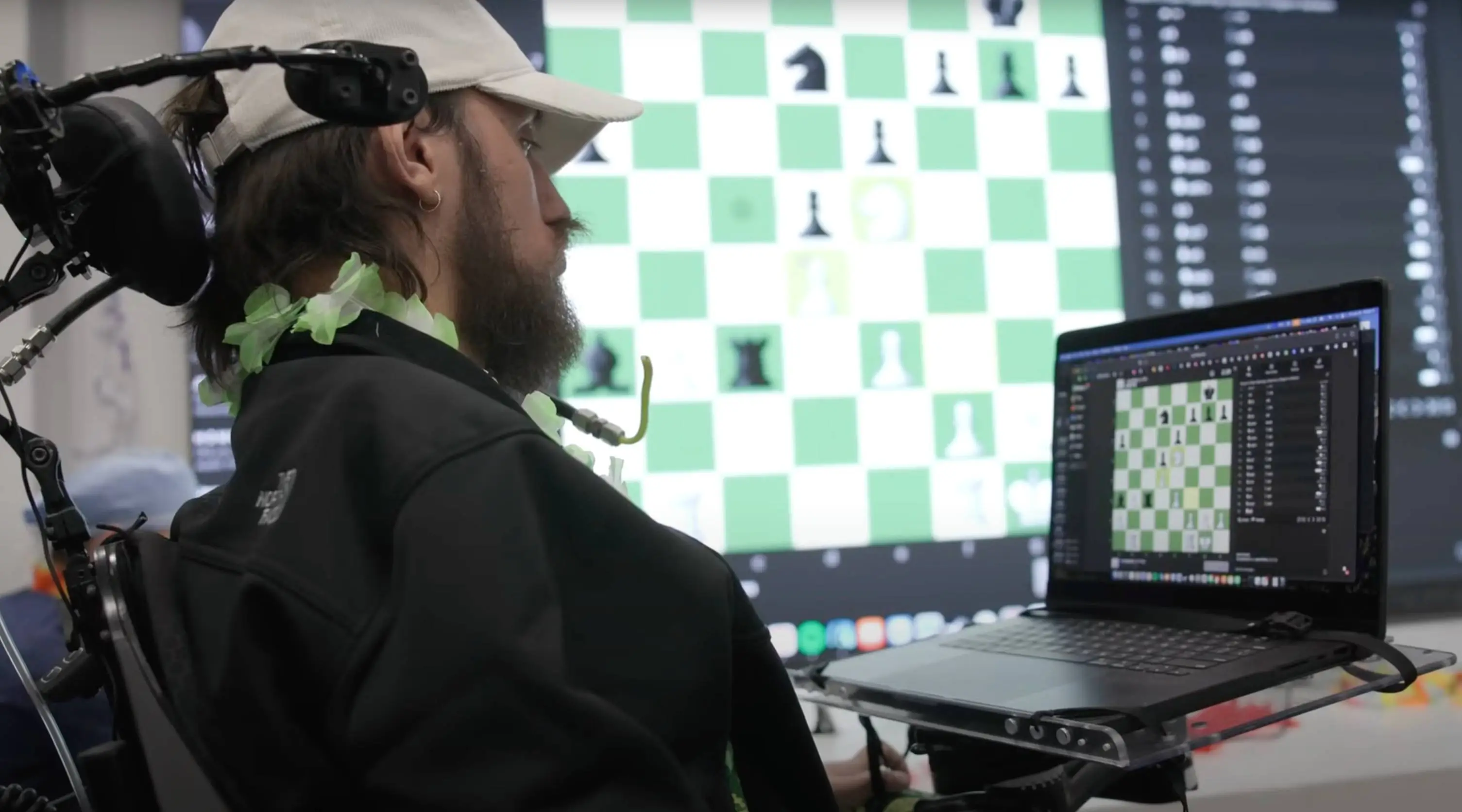 Neuralink is set to massively increase its trials before the end of 2025 (YouTube / Barrow Neurological Institute)