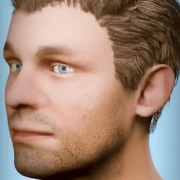 Fascinating animation shows how hair transplants work