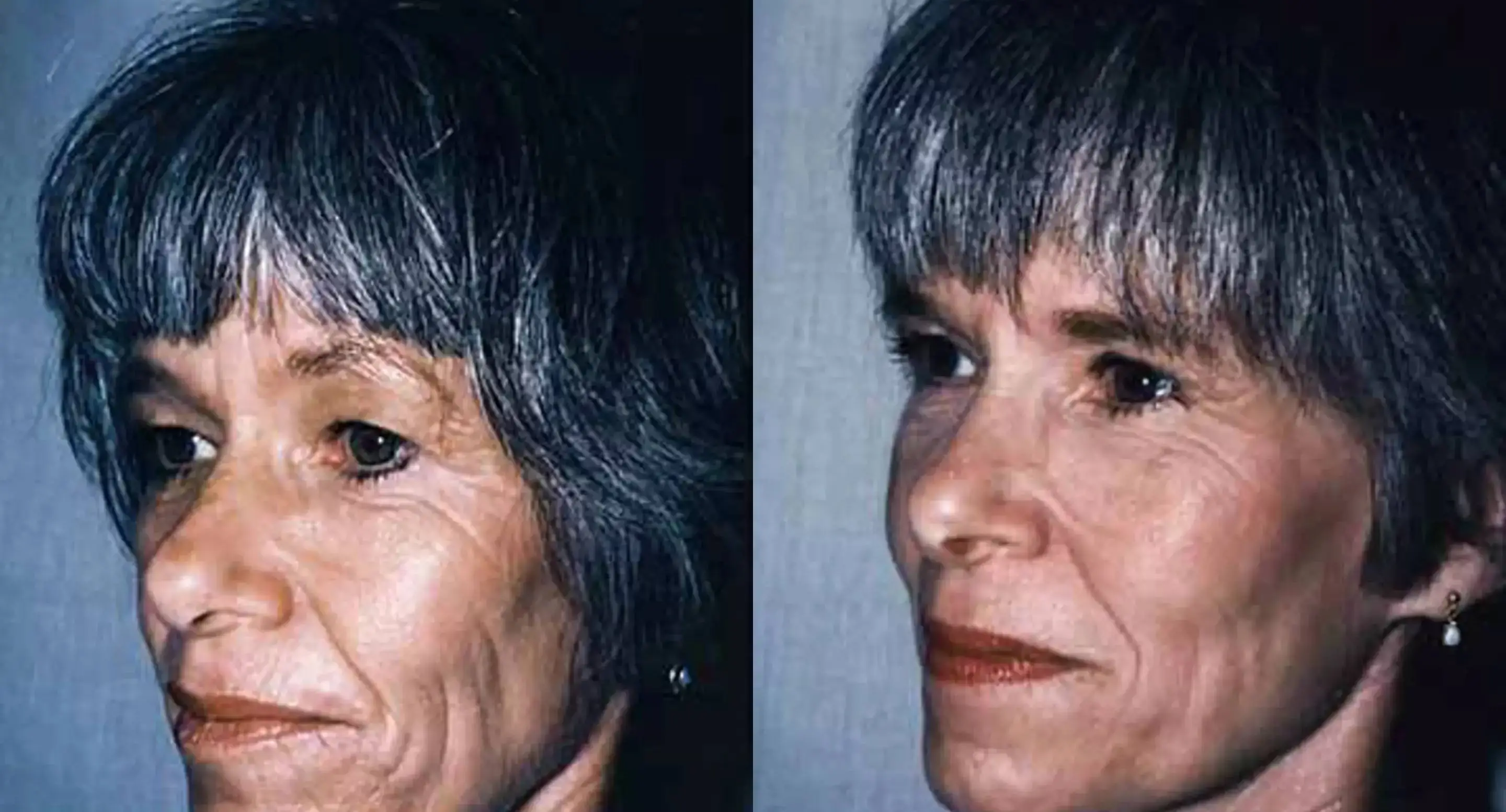 Gay Block (L) and Gwen Sirota (R) were shocked by the differences in their looks (Darrick E. Antell, M.D)