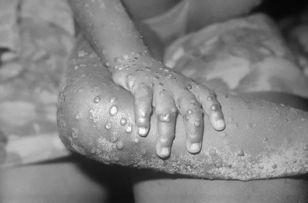 A new hybrid strain of mpox has appeared in the United Kingdom for the first time, leaving experts fearful (CDC/Getty Images)