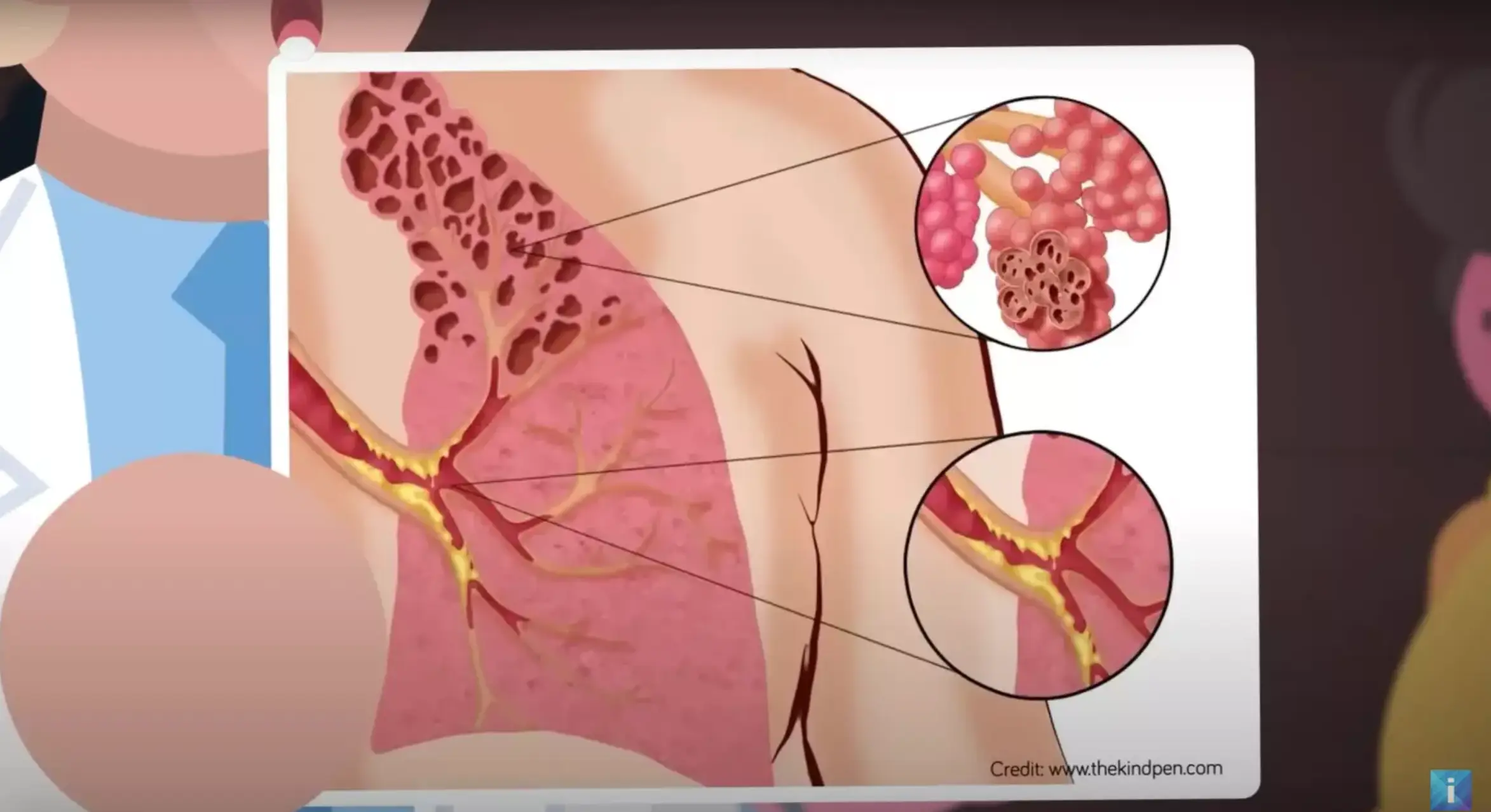 A simulation on YouTube shows just how damaging e-liquid can be to your lungs (YouTube/The Infographics Show)