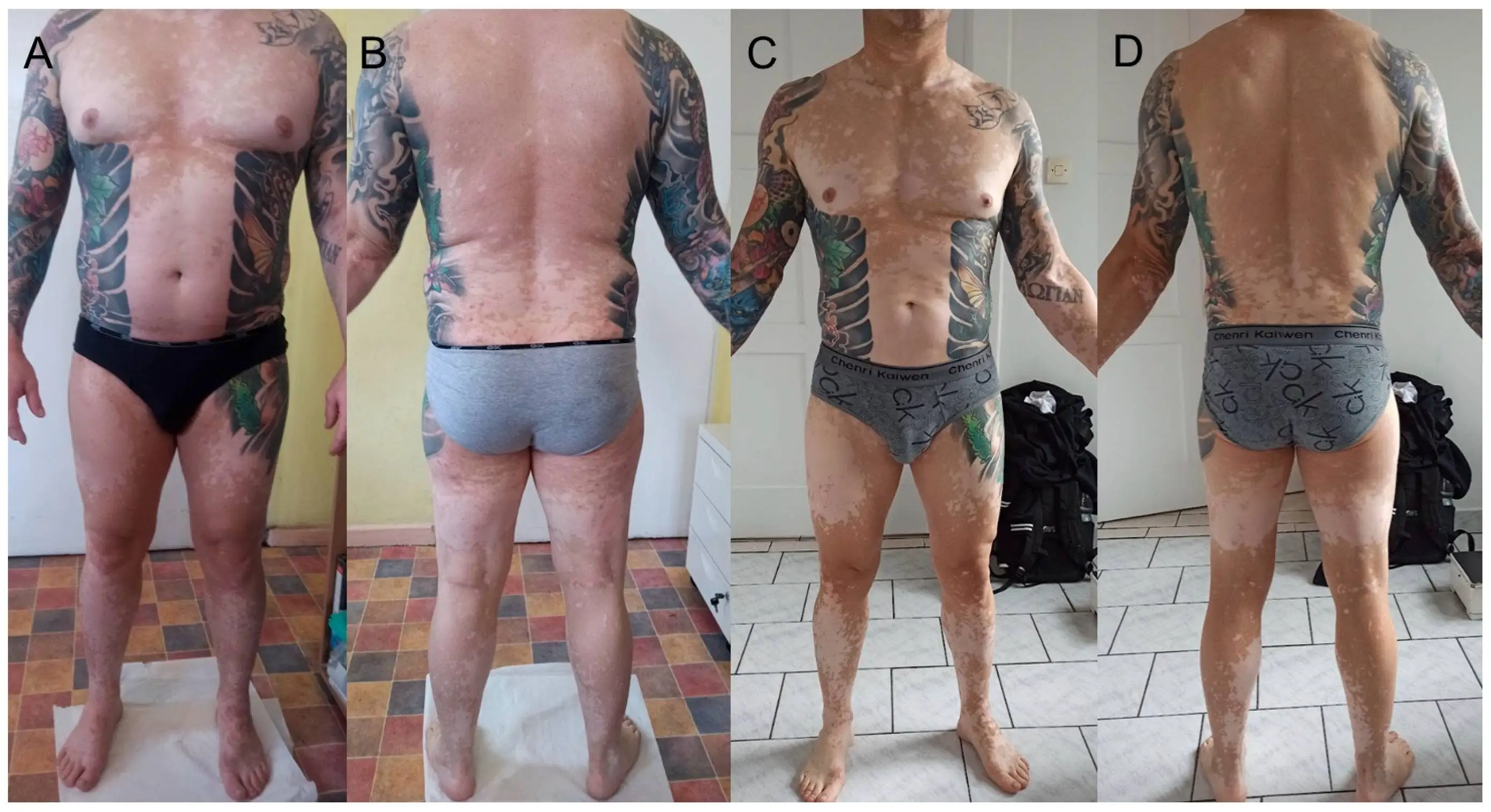 He's been permanently affected by the tattoo (Wroclaw Medical University / Clinics and Practice)