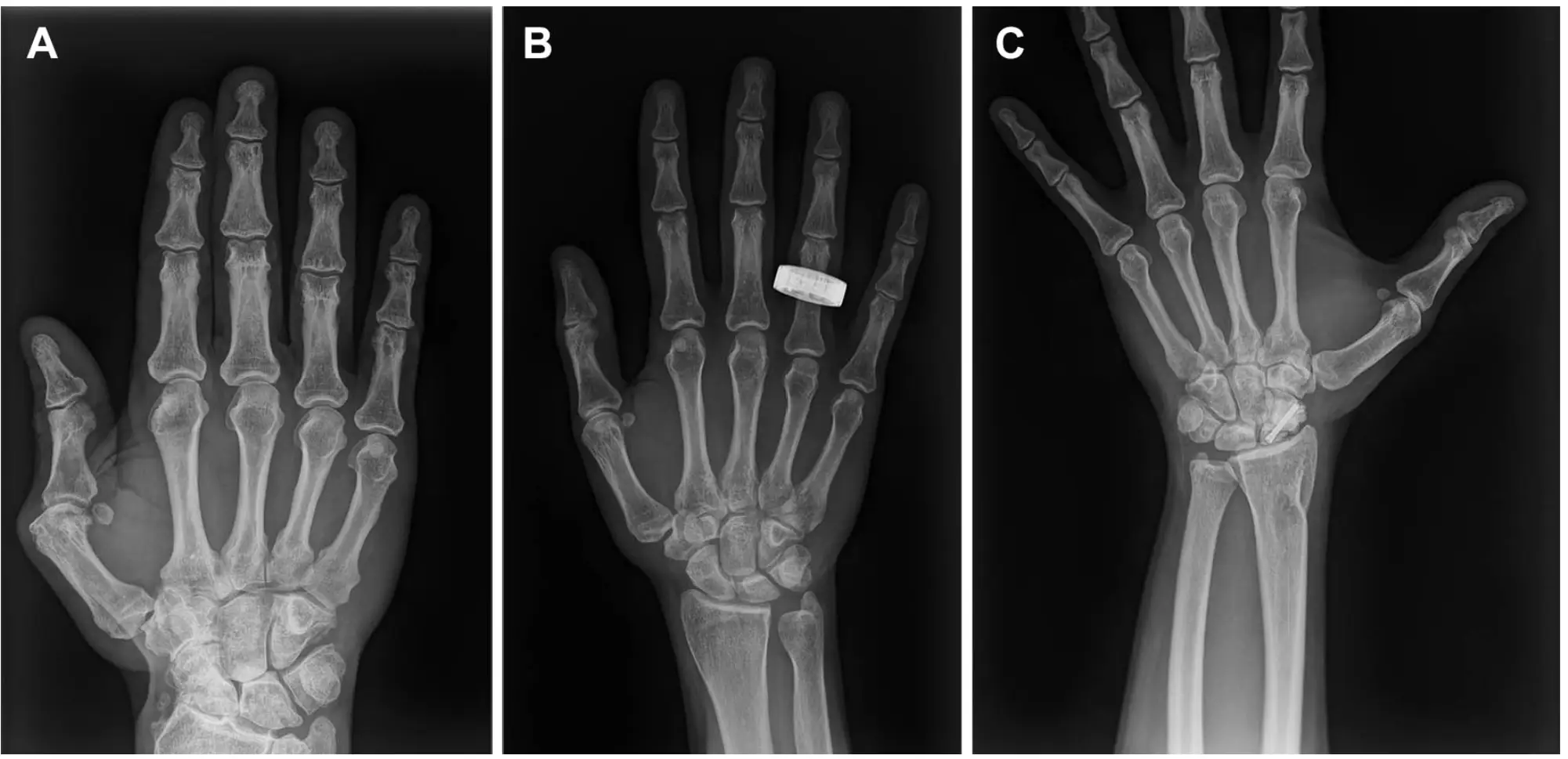 Hand X-rays taken in pre-flight, in orbit, and post-flight (Gifford et al., Radiology)