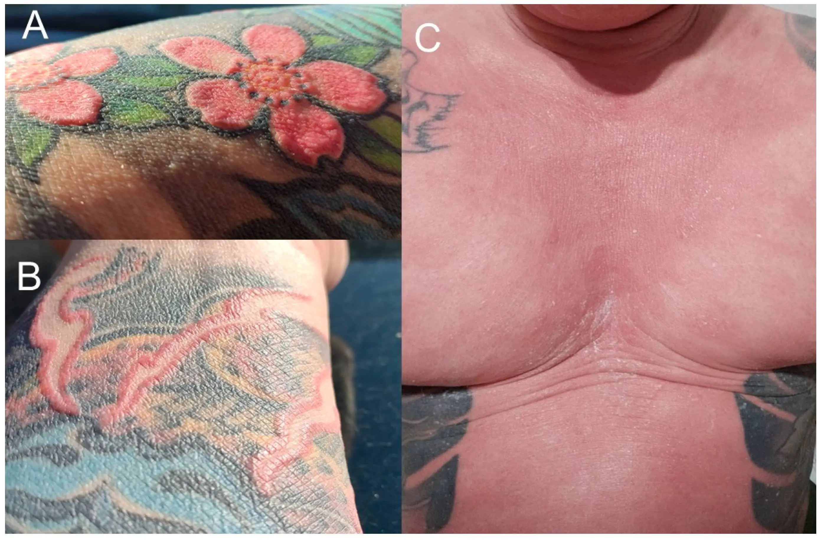 He had to have eight operations to remove the ink (Wroclaw Medical University / Clinics and Practice)