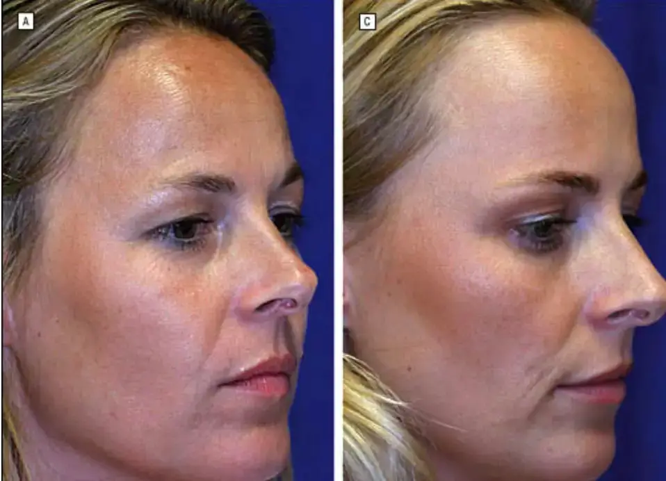 Twin A (left) only had two botox injections across the study's duration, whereas Twin B (right) had two to three every year (American Society for Dermatologic Surgery)