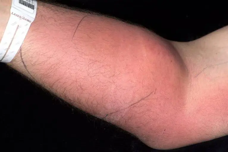 He'd been regularly injecting for the past 18 months (Irish Medical Journal)