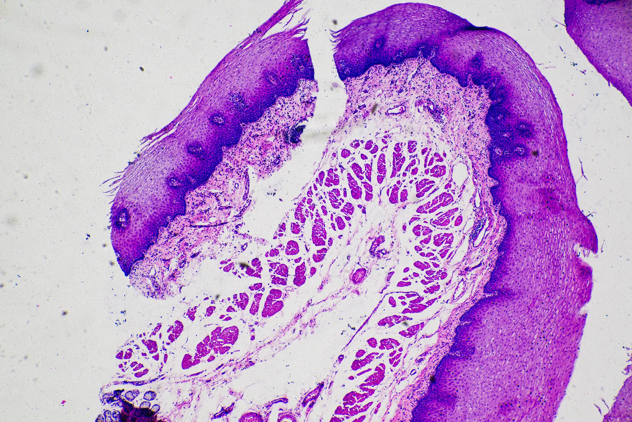 The woman's cSCC continued to spread after HPV invaded the cells and spread them through the production of viral proteins (Getty Stock)