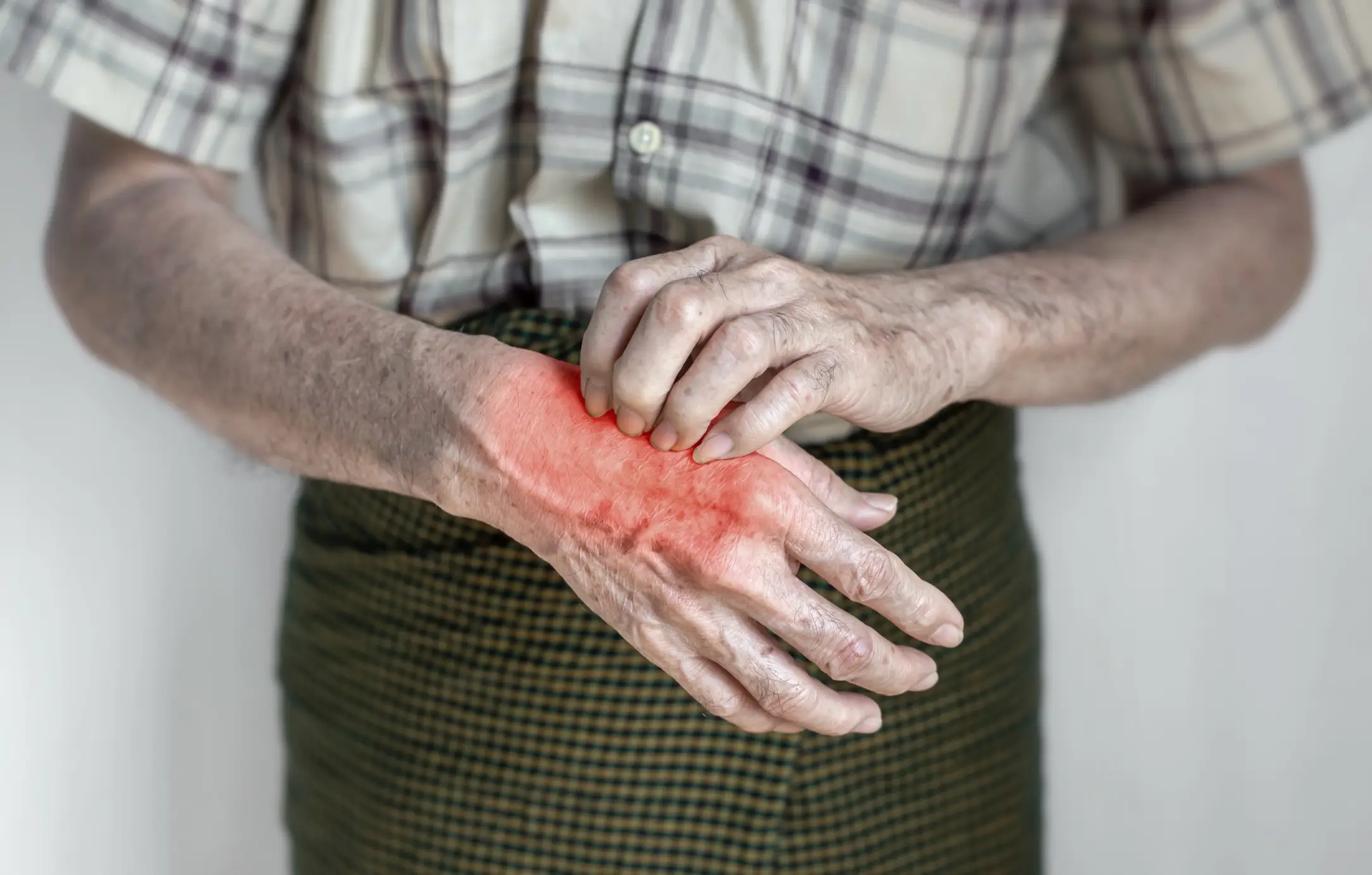Scabies rashes appear most frequently on the hand but can spread throughout the body, leaving its victim in a nightmarish situation (Getty Stock)