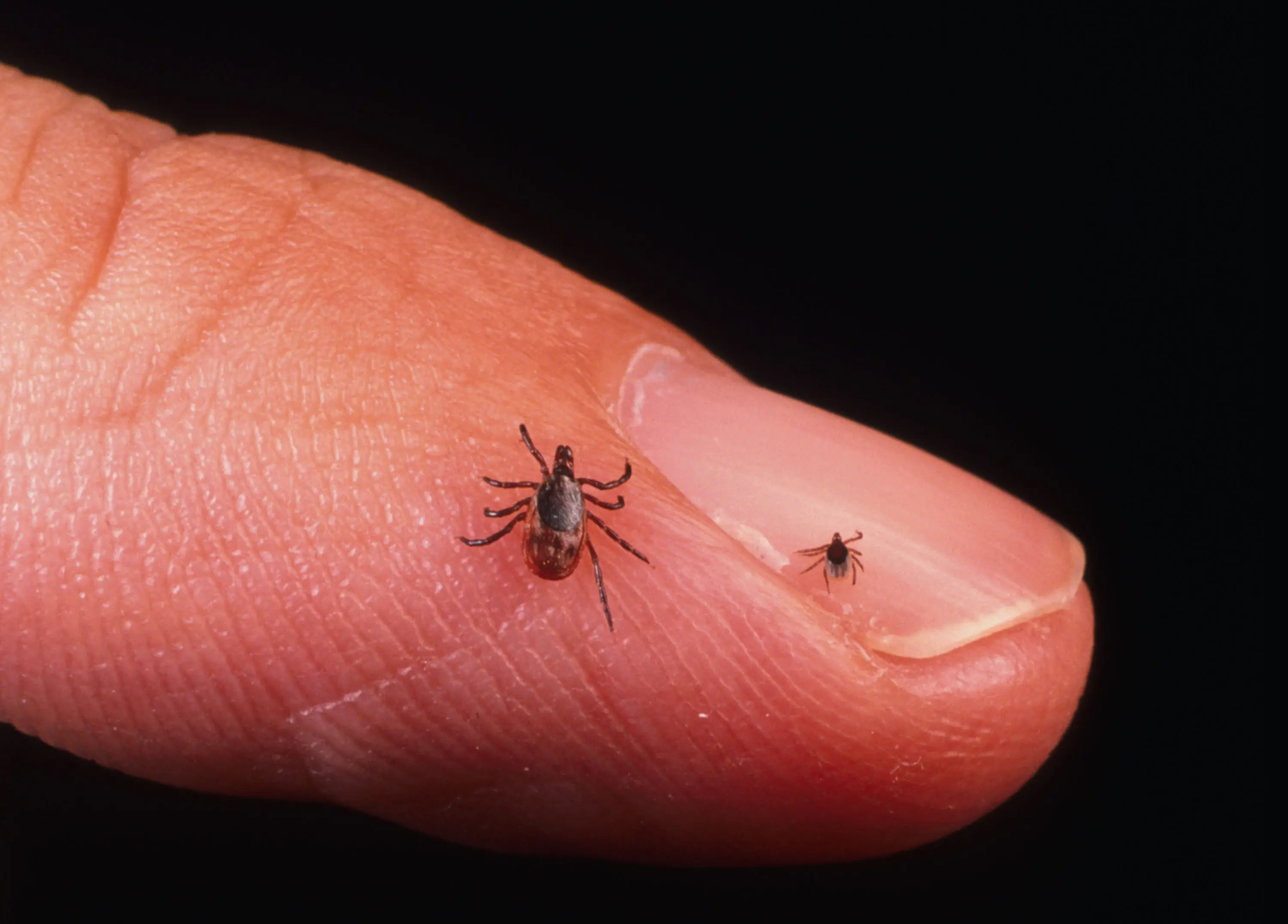 The syndrome can be triggered by a tick bite (Stringer/Getty Images)