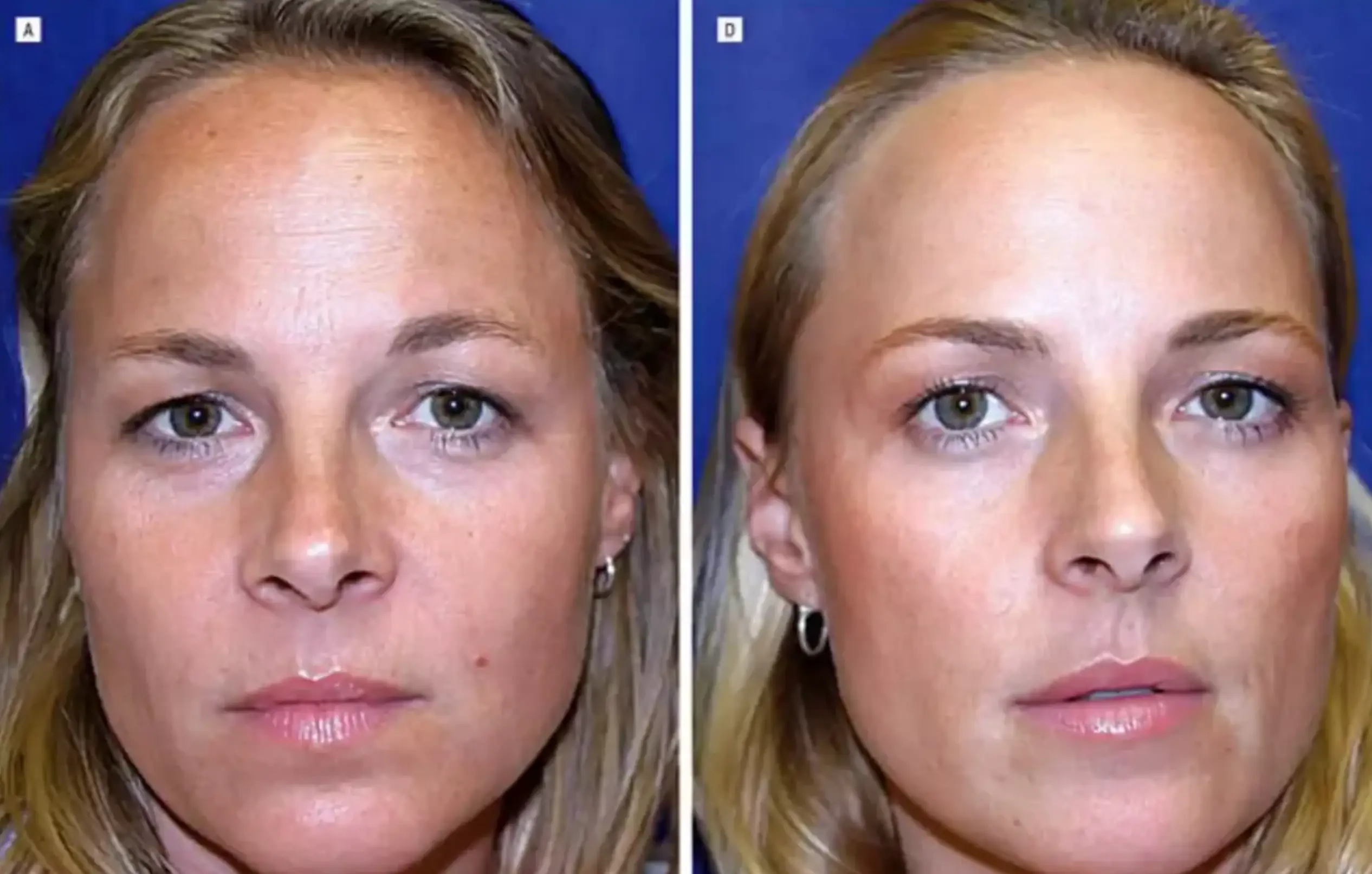 Twin 1 (left) had more noticeable wrinkles after 13 years with minimal Botox (American Society for Dermatologic Surgery)