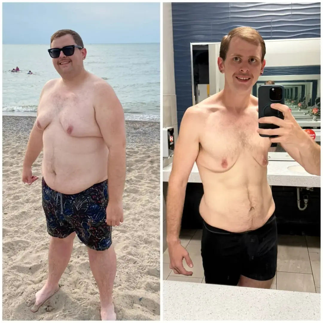 Jacob also encountered hanging skin as a consequence of rapid weight loss, and is working on filling it out with strength training (Reddit/Jk-1996)